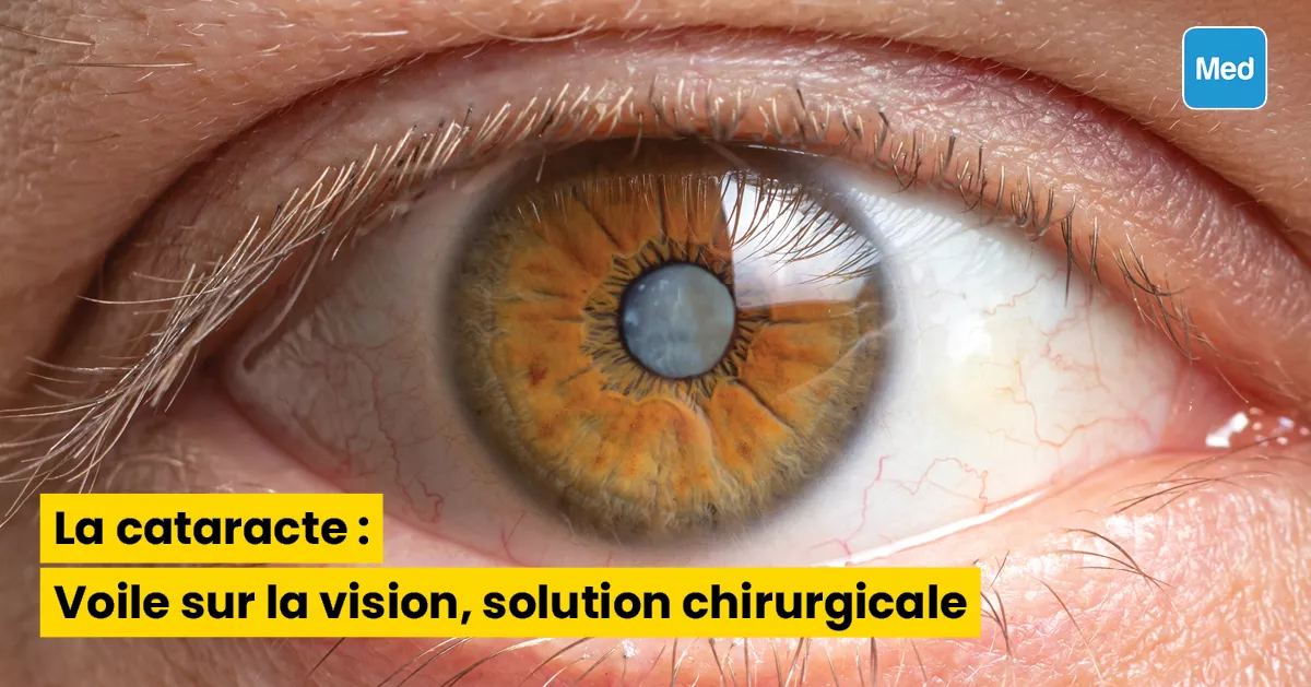 La cataracte : Voile sur la vision, solution chirurgicale